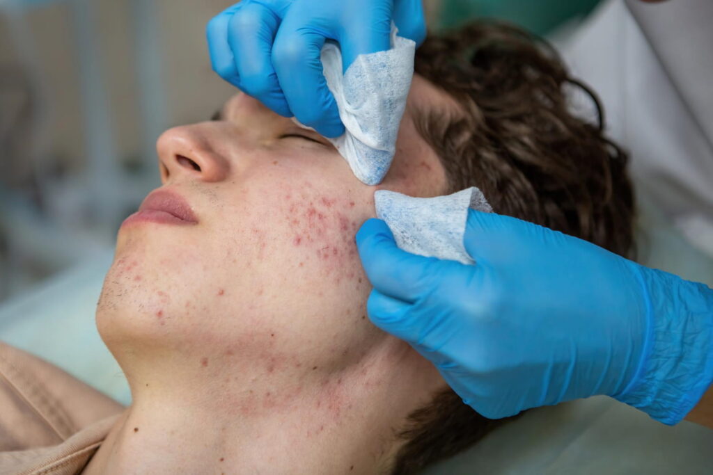 eliminación de acné y marcas en clínica estética Cádiz